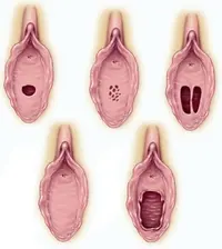 hymen(1).webp